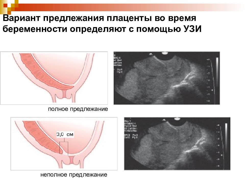 Плацента внутренний зев