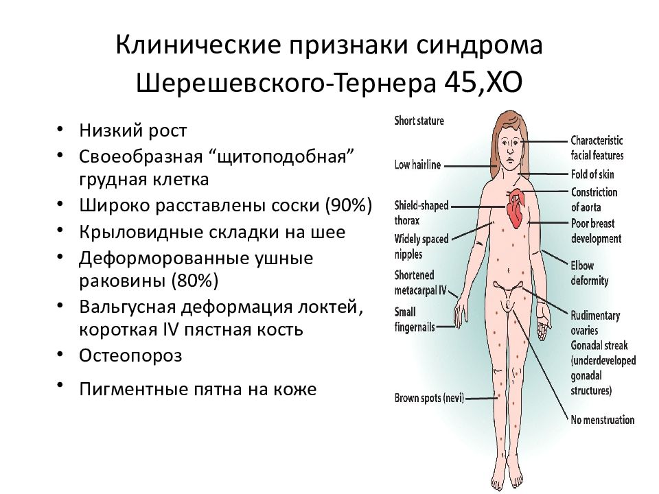 Шерешевского тернера презентация