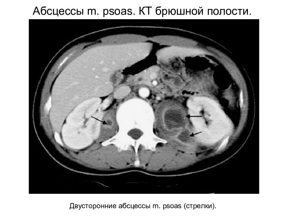 Абсцесс брюшной полости презентация