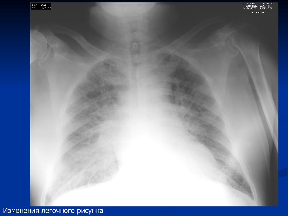 Изменение легочного рисунка. Повышенная прозрачность легочных полей на рентгенограмме. Изменение легочного рисунка заболевания. Повышенная прозрачность легочных полей на рентгене. Повышение прозрачности легочных полей.