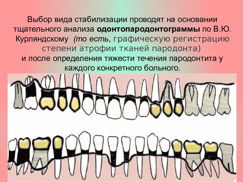 Постоянное шинирование при заболеваниях пародонта презентация