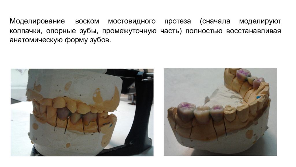 Части мостовидного протеза. Восковое моделирование цельнолитого мостовидного протеза. Моделирование воском мостовидного протеза. Моделирования воском комбинированной части мостовидного протеза. Моделирование промежуточной части мостовидного протеза.