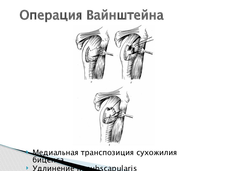 Привычный вывих плечевого сустава. Операция Вайнштейна при привычном вывихе. Привычный вывих плеча операция. Операция по Вайнштейну плечо. Вывих плеча операция Вайнштейна.