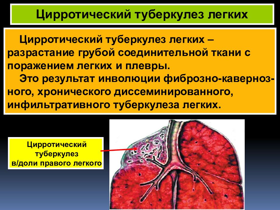 Туберкулез и гепатиты презентация