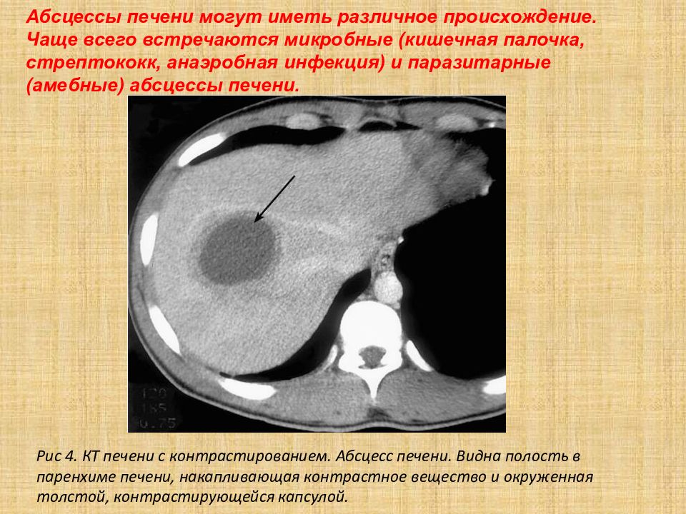 Абсцесс печени кт картина