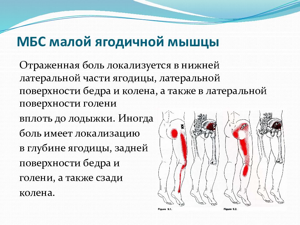 Миофасциальный болевой синдром презентация