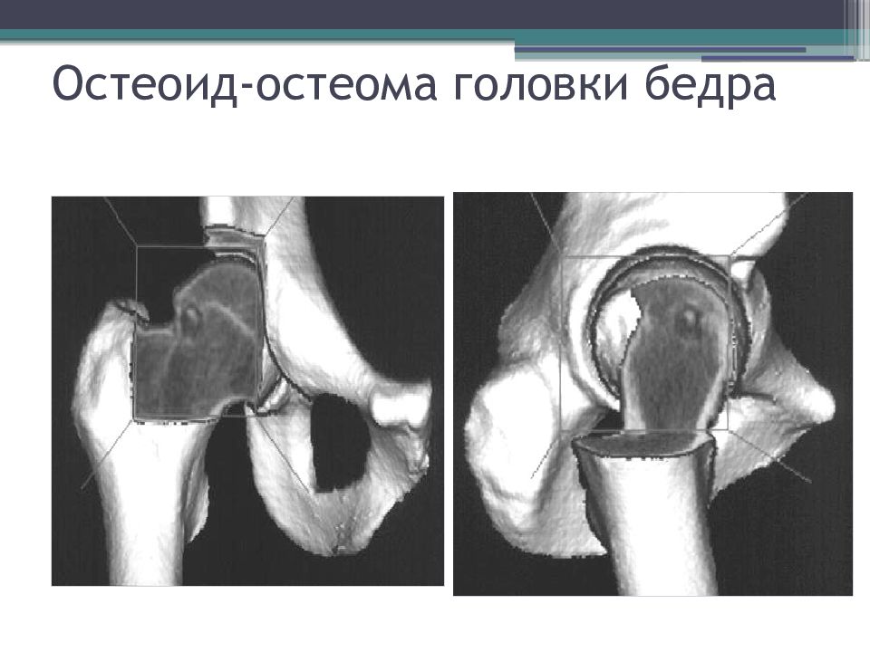 Кт шейки бедра. Остеоид-остеома бедренной кости кт. Остеоид-остеома бедренной кости рентген. Остеоид остеома рентген.