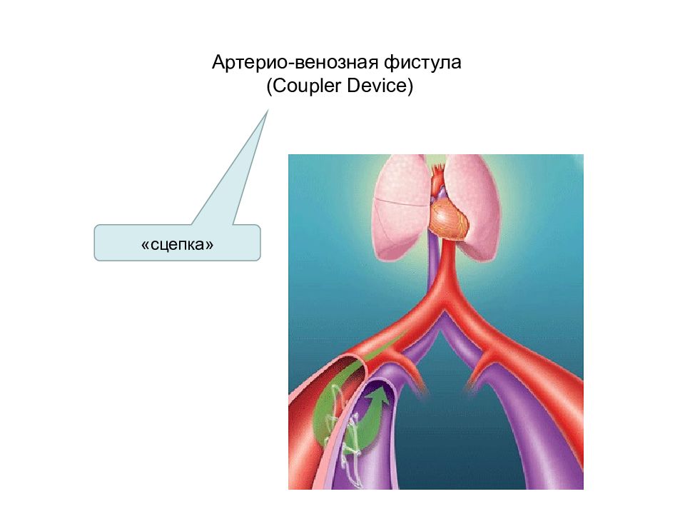 Фистула в сердце