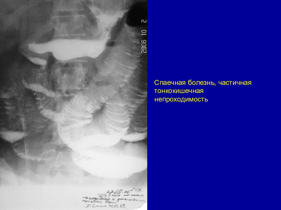 Спаечная болезнь. Спаечная кишечная непроходимость рентген. Спаечная болезнь кишечника рентген. Спаечная кишечная непроходимость УЗИ. Непроходимость спайки.