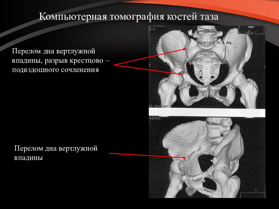 Переломы таза у детей презентация