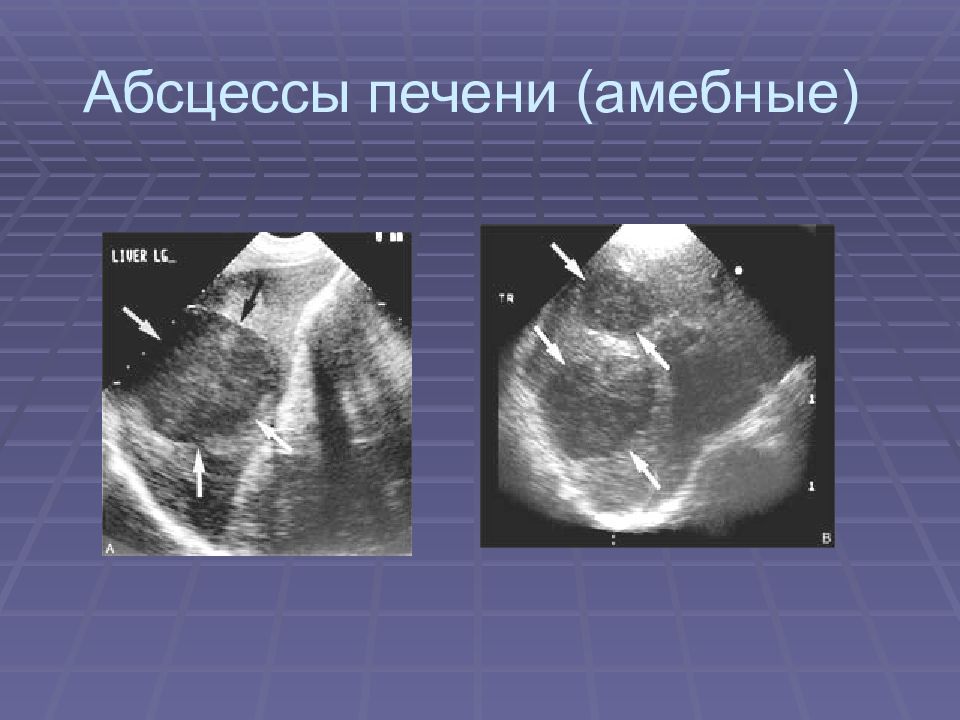 Абсцесс печени узи картина