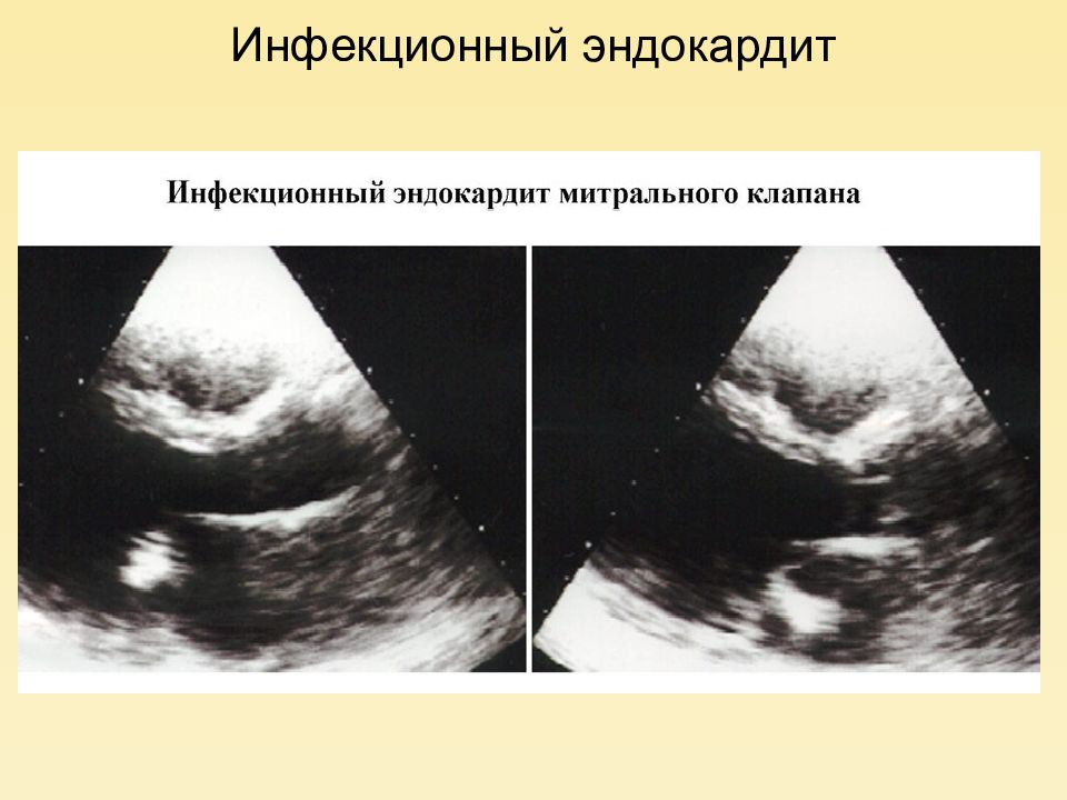 Инфекционный эндокардит презентация