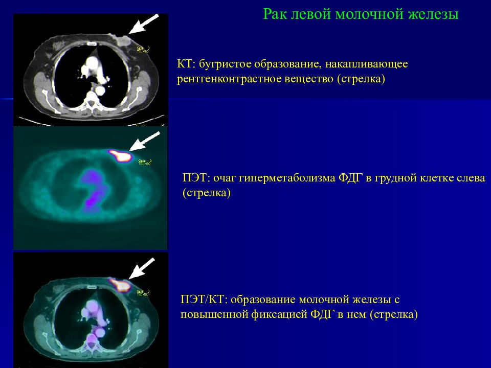 Фдг в онкологии. ПЭТ кт молочной железы. Образование молочной железы на кт. ПЭТ лучевая диагностика.