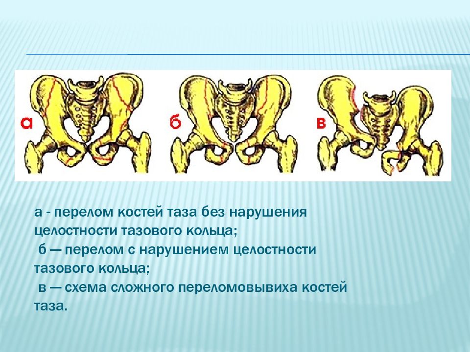 Повреждения таза презентация