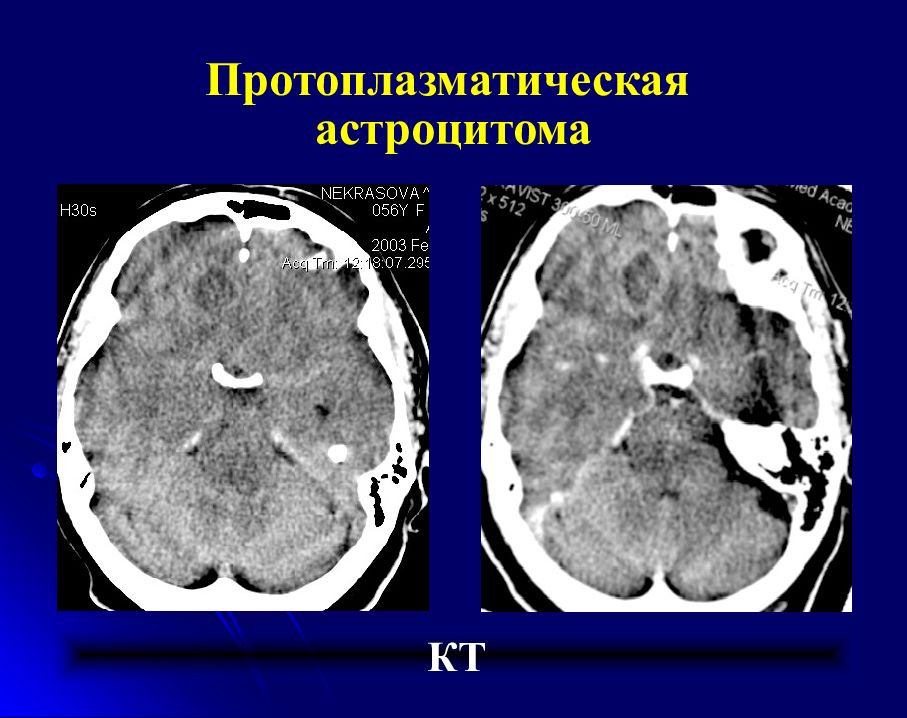 Кт кв. Протоплазматическая астроцитома. Фибриллярная астроцитома. Астроцитома головного мозга кт.