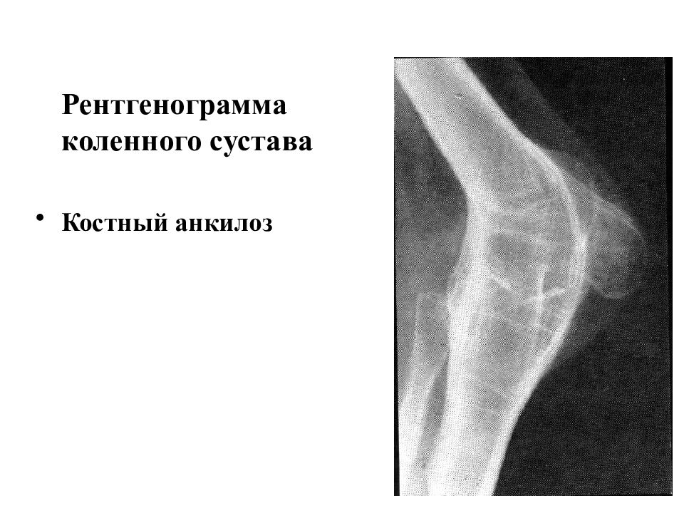 Анкилоз сустава. Анкилоз сустава рентген. Фиброзный анкилоз рентген. Костный анкилоз на рентгене. Костный анкилоз коленного сустава.