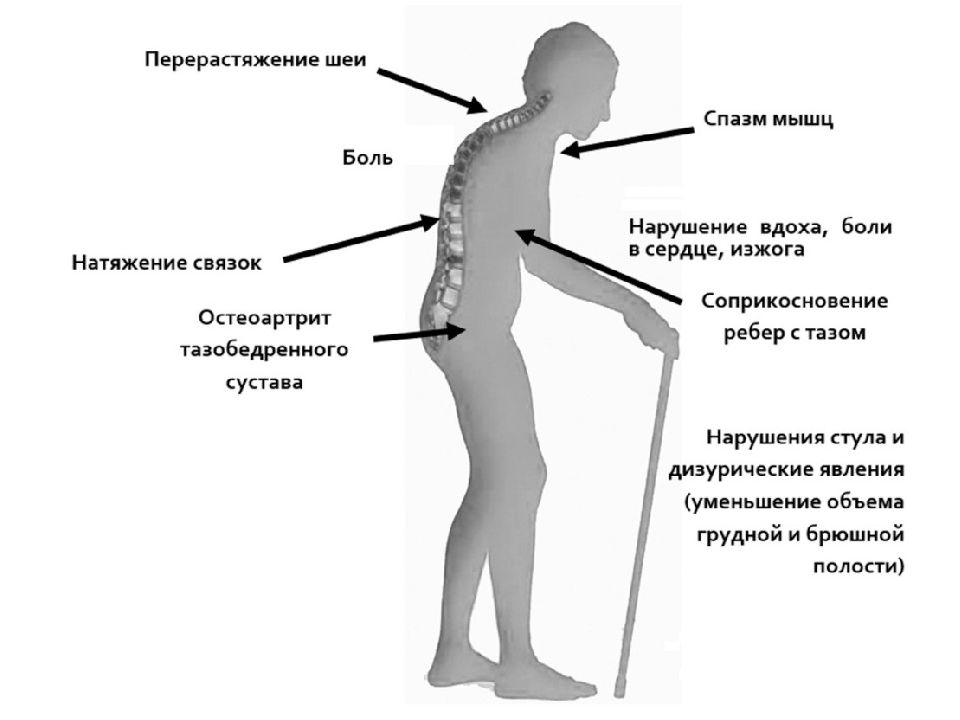 Остеопороз клиническая картина