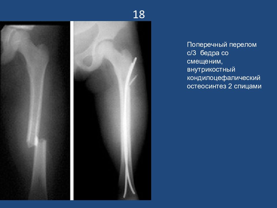 Презентация переломы диафиза бедренной кости