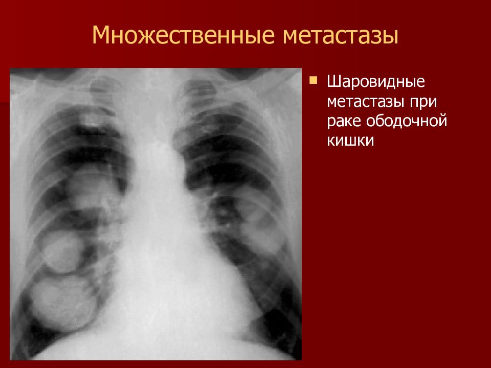 Метастазы это. Шаровидная опухоль легкого. Рентгенодиагностика метастатических опухолей лёгких.. Вторичное злокачественное новообразование легкого.