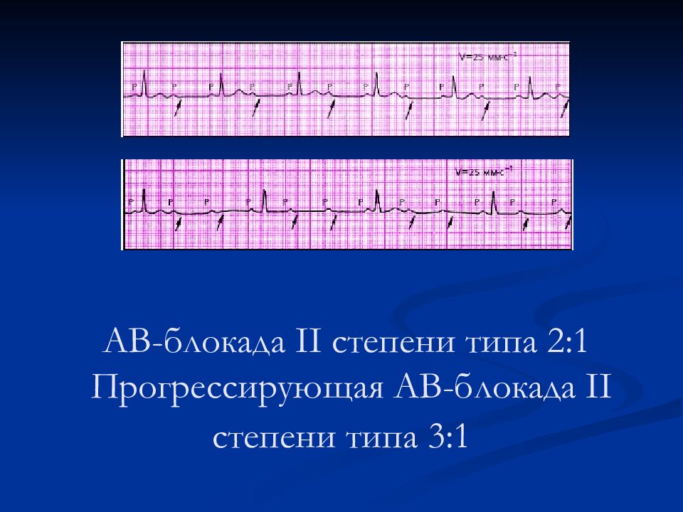 Ав блокада степени. АВ блокада 2 степени Мобитц 1 ритм. Атриовентрикулярная блокада 2 степени 1 типа. АВ блокада 2 степени Мобиц 3. АВ блокада 2 степени 1 типа 3:1.