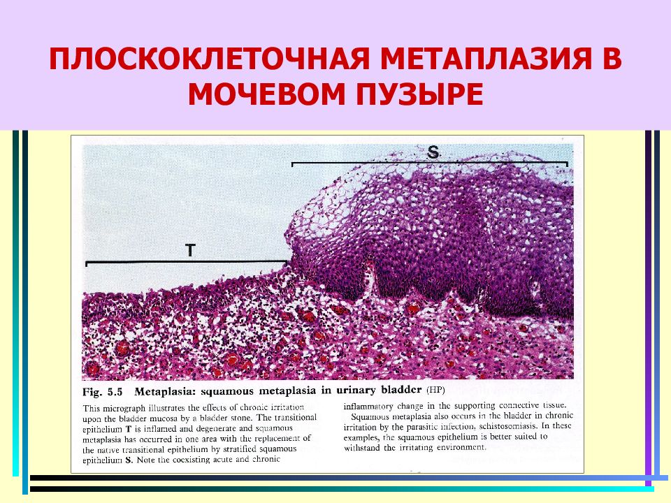 Плоскоклеточный эндометрий. Плоскоэпителиальная метаплазия. Плоскоклеточная метаплазия гистология. Метаплазия эндометрия гистология. Плоскоклеточный эпителий шейки матки.