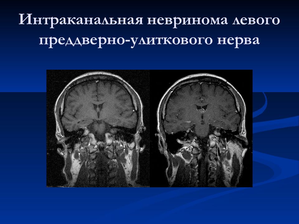 Невринома. Невринома преддверно-улиткового нерва. Невринома преддверно-улиткового нерва мрт. Шваннома преддверно-улиткового нерва. Опухоли преддверно улитковый нерв.