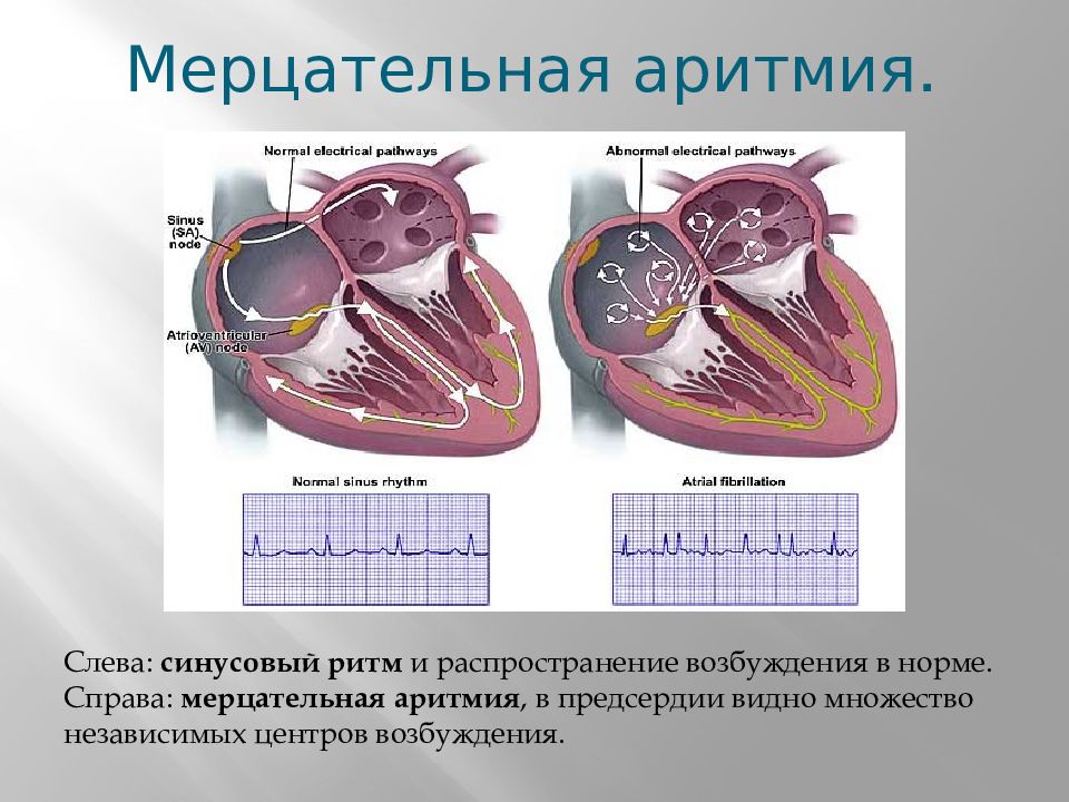 Ав блокада презентация