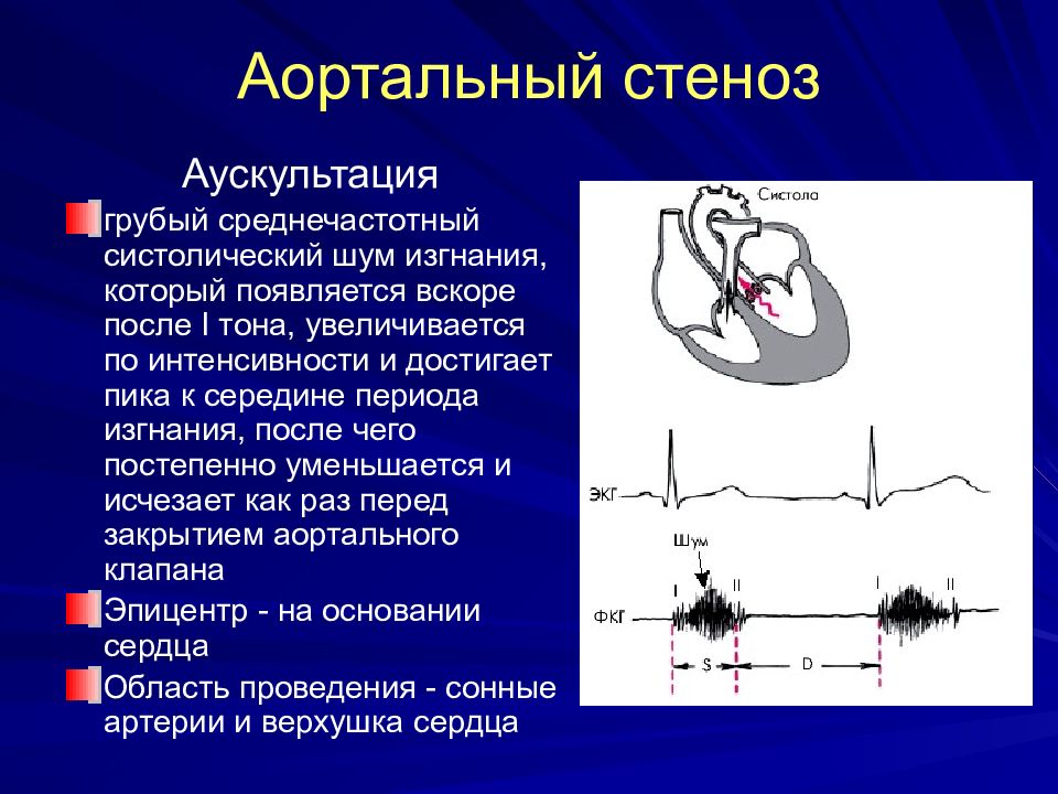 Причины стеноза аортального клапана. Аортальный стеноз грубый систолический шум. Шум при стенозе аортального клапана. Стеноз устья аорты систолический шум. Аускультация сердца тоны при аортальном стенозе.