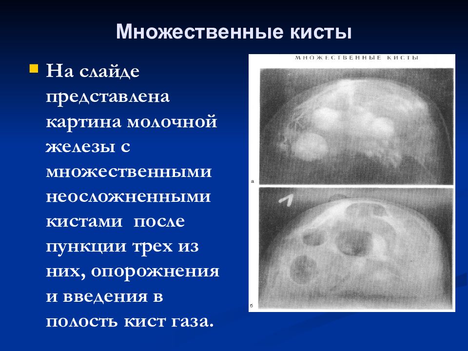 Анализ кисты молочной железы