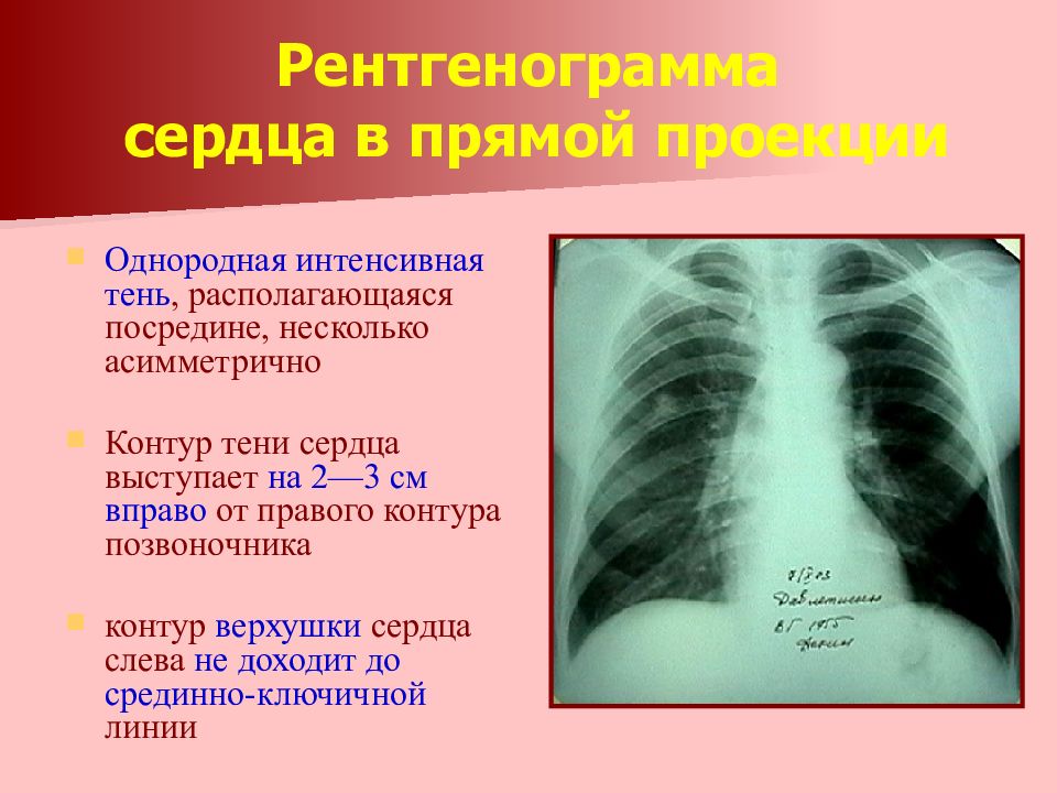 Тени сердца. Тень сердца на рентгенограмме. Сердце в прямой проекции на рентгенограмме. Сердечная тень на рентгенограмме. Дуги сердца на рентгенограмме.