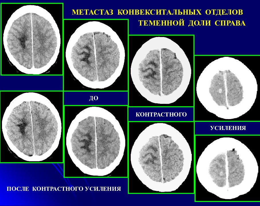 Конвекситальные пространства. Конвекситальная опухоль. Конвекситальные отделы. Конвекситальная менингиома. Конвекситальные отделы мозга.