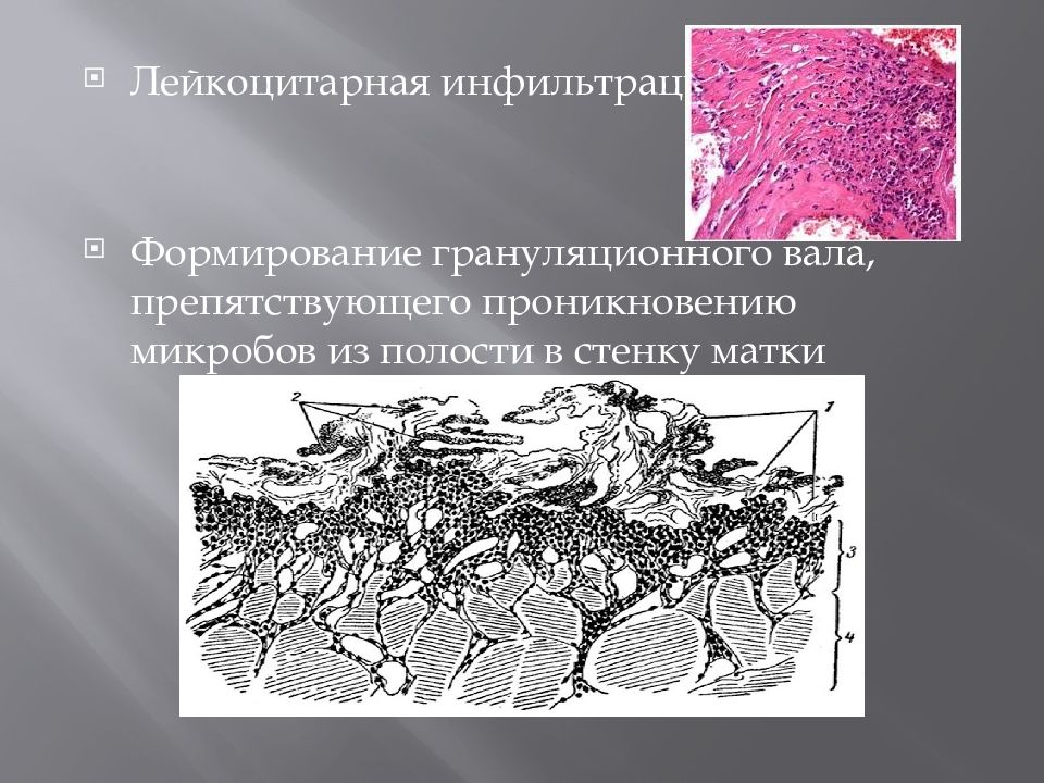 Лейкоцитарная инфильтрация в мазке что это значит