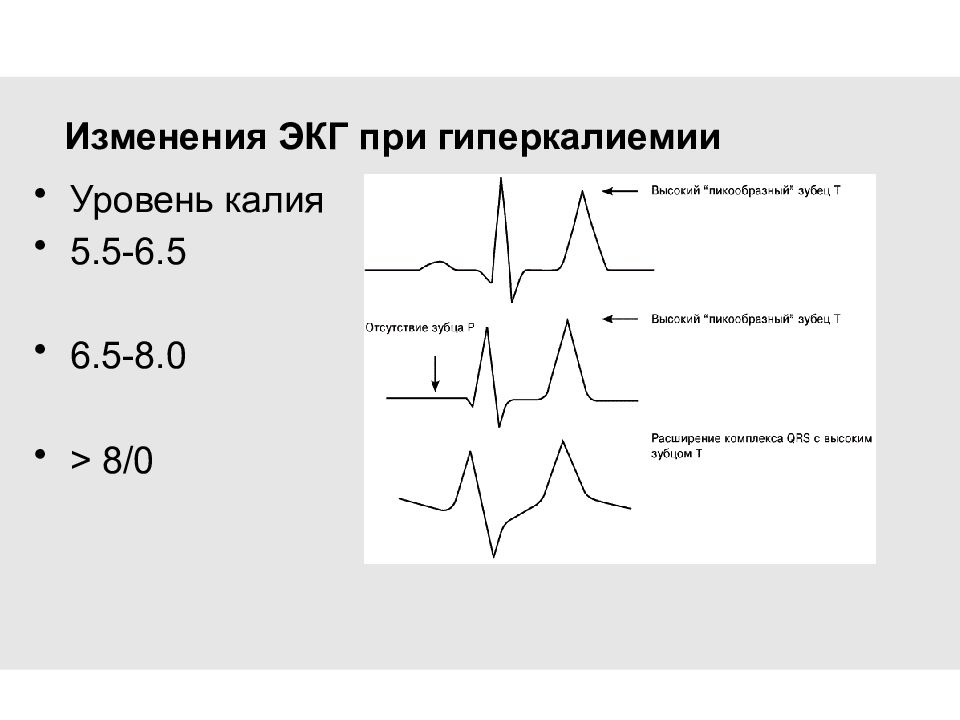 Гиперкалиемия экг картина