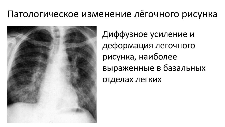 Легочный рисунок в базальных отделах. Легочный рисунок диффузно усилен. Диффузное усиление легочного рисунка. Усиление и деформация легочного рисунка. Диффузное изменение легочного рисунка что это такое.