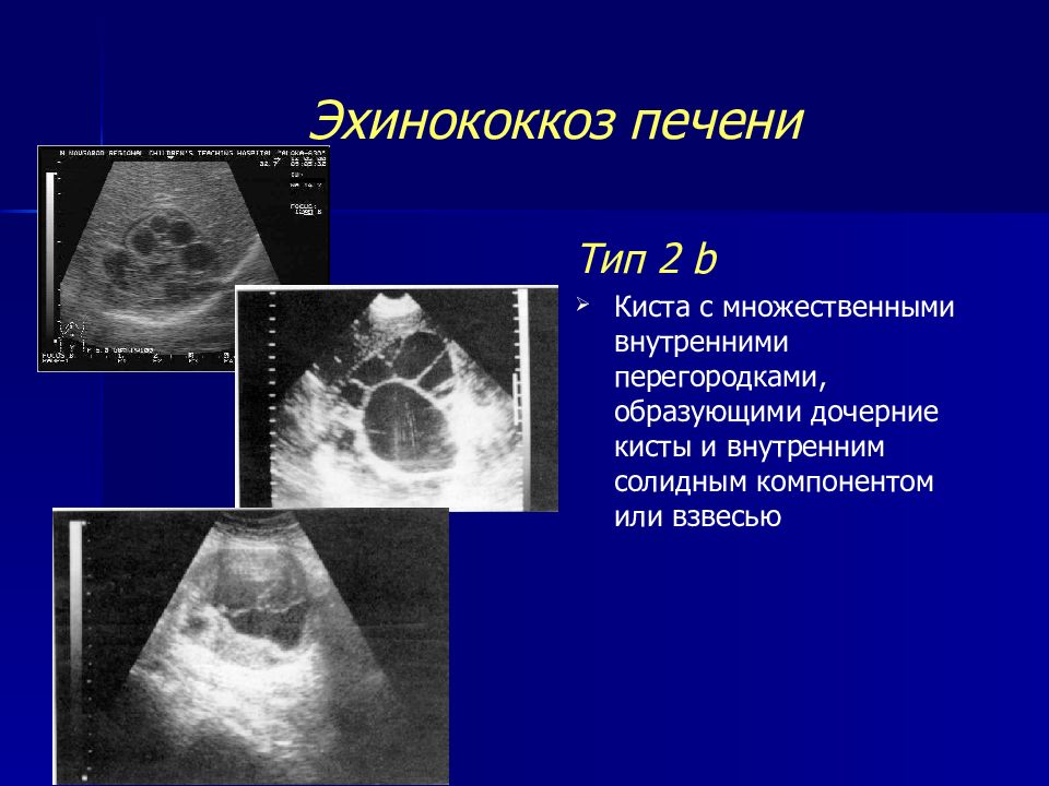 Эхинококковая киста печени в ультразвуковом изображении характеризуется