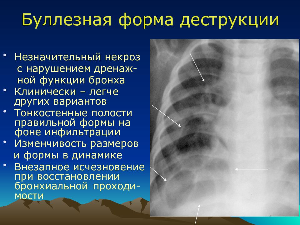 Острая гнойная деструктивная пневмония у детей презентация