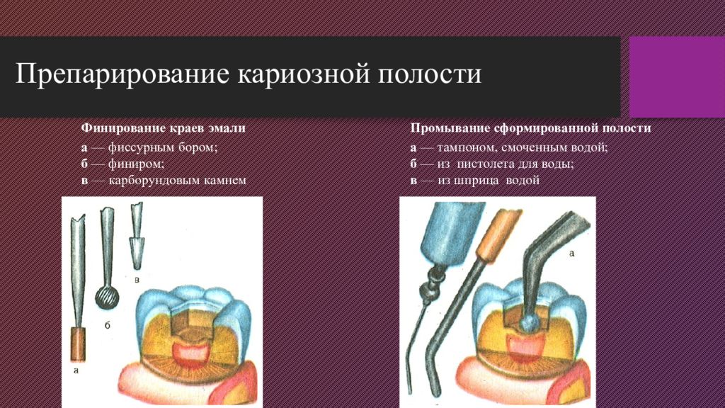 Сделай полости. Финирование краев полости. Финирование краев кариозной полости. Финирование краёв эмали. Промывание кариозной полости.