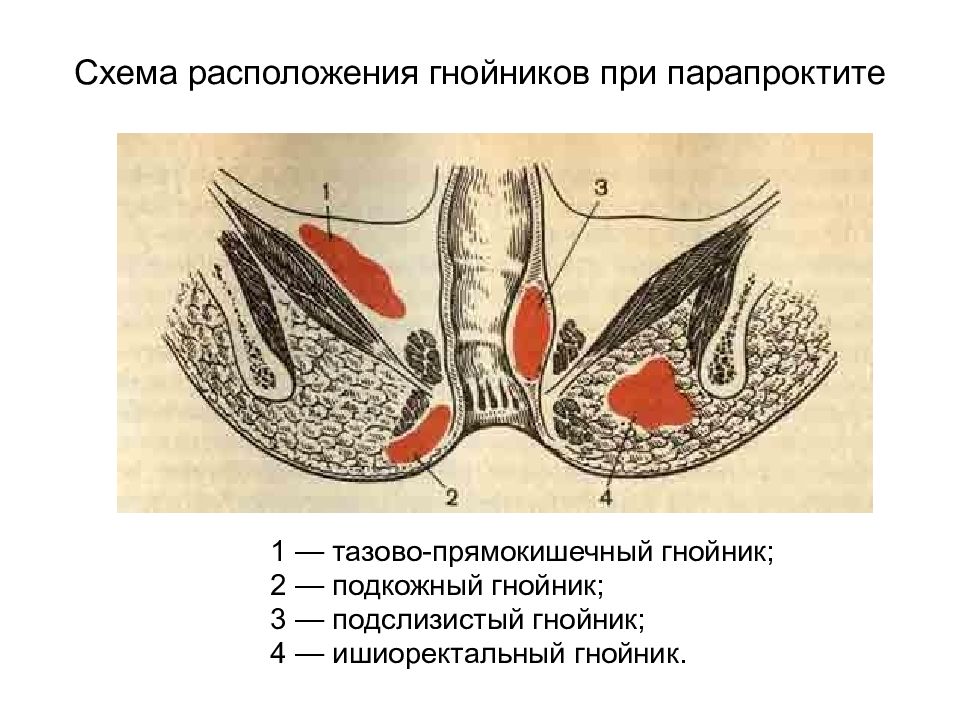 Хронический парапроктит презентация