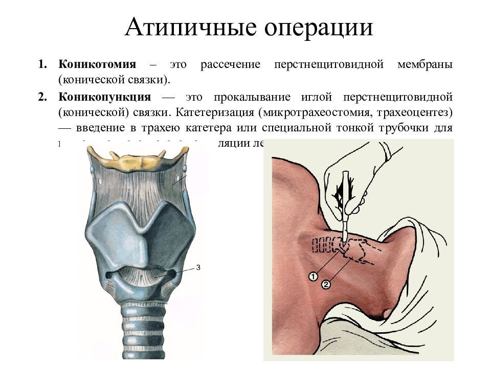 Трахеостомия у взрослых. Коникотомия это микротрахеостомия это. Коникотомия показания техника. Экстренная коникотомия. Коникотомия осложнения.