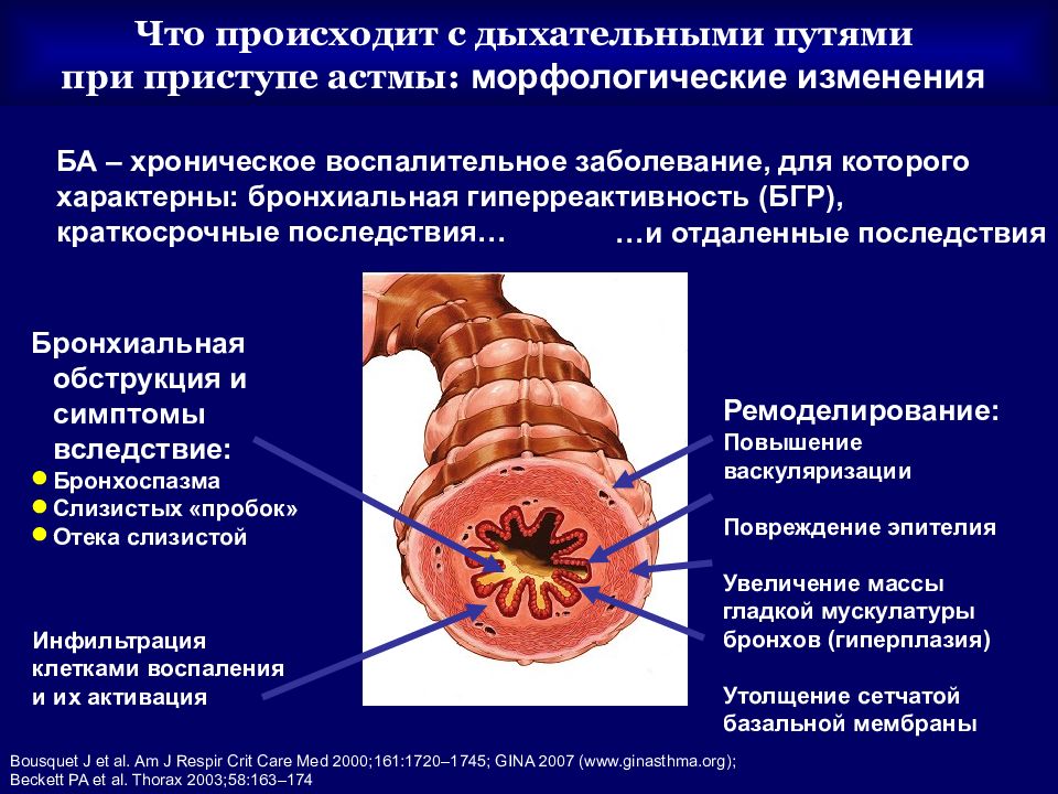 Бронхиальная астма симптомы. Бронхиальная обструкция при бронхиальной астме. Обструкция дыхательных путей при бронхиальной астме. Бронхиальная обструкция при бронхиальной астме обусловлена. Бронхиальная астма презентация.