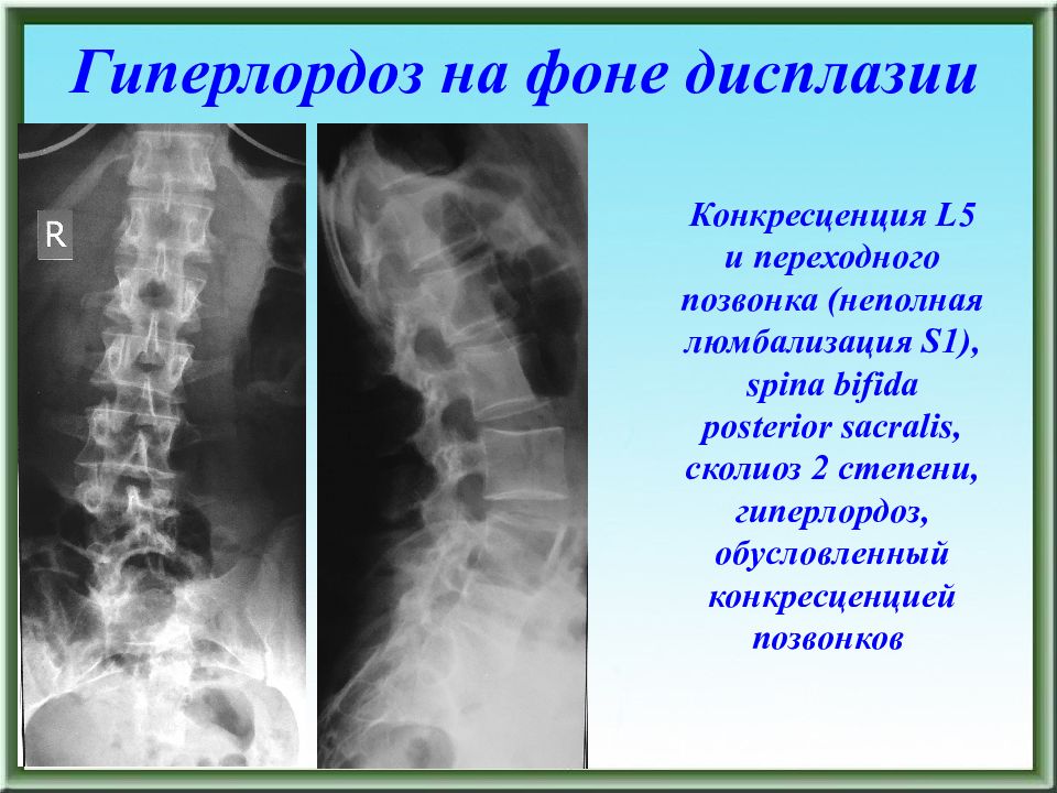 Конкресценция позвонков. Люмбализация s1 позвонка рентген. Люмбализация l5. Люмбализация s1 рентген. Люмбализация th12.