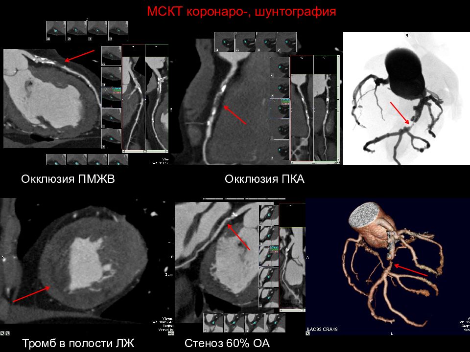 Атеросклероз мрт. Кт-ангиография коронарных артерий. Мультидетекторная компьютерная томография. Коронарография атеросклероз. Кт ангиография сердца коронарных артерий.