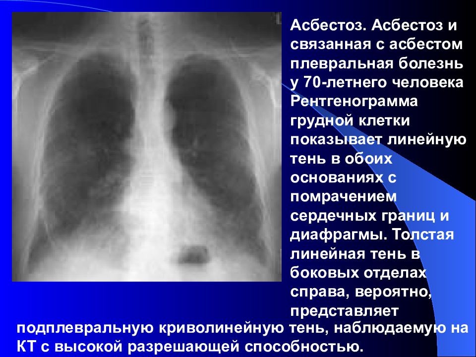 Асбестоз это. Асбестоз профессиональное заболевание. Асбестоз на рентгенограмме.