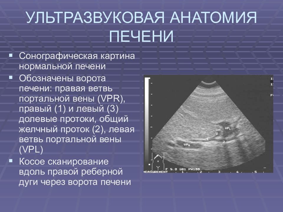 Круглая связка печени на узи картинки