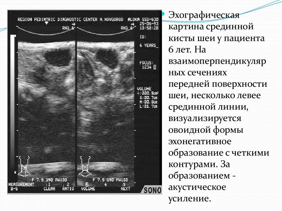 Эхографическая картина неизмененной аорты при поперечном сканировании тест