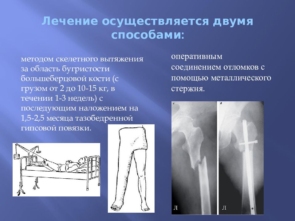 Презентация переломы диафиза бедренной кости