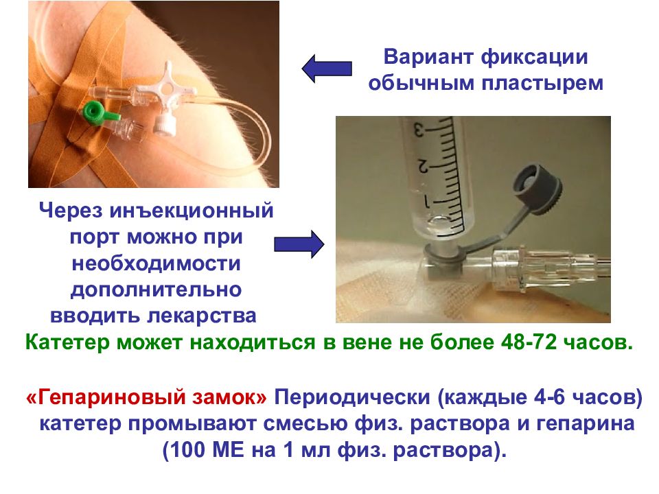 Постановка периферического венозного катетера картинки