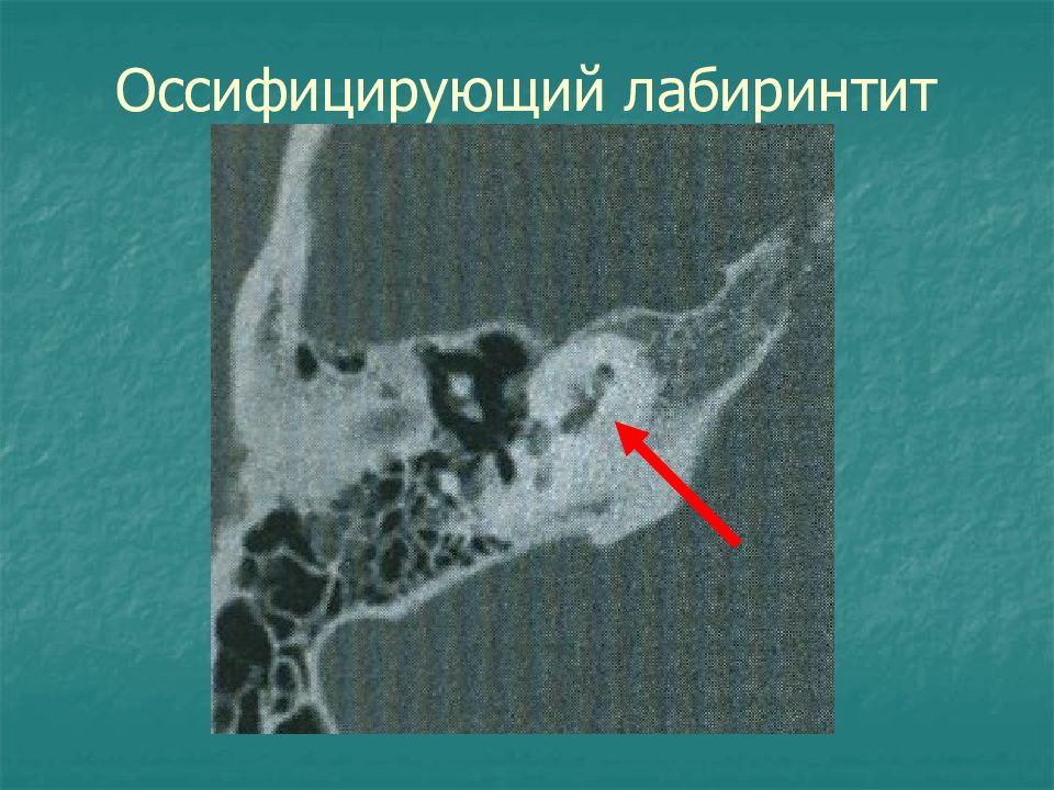 Острый лабиринтит презентация