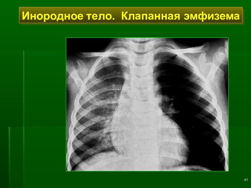 Лучевая диагностика хобл презентация