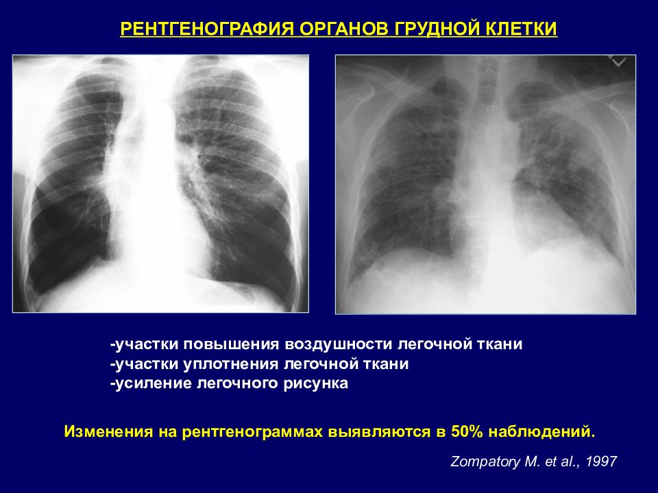 Усиление легочного рисунка в прикорневых зонах что это значит у взрослого